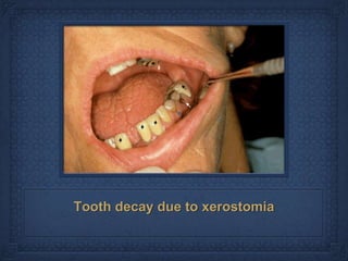 Tooth decay due to xerostomia
 