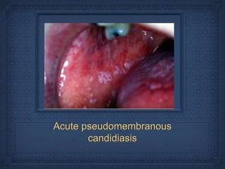 Acute pseudomembranous
       candidiasis
 
