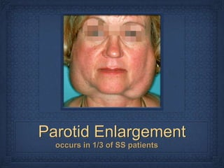 Parotid Enlargement
  occurs in 1/3 of SS patients
 