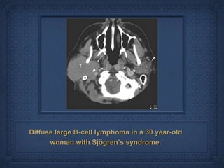 Diffuse large B-cell lymphoma in a 30 year-old
      woman with Sjögren’s syndrome.
 