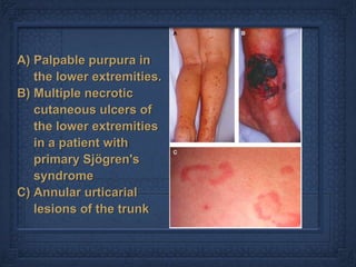 A) Palpable purpura in
   the lower extremities.
B) Multiple necrotic
   cutaneous ulcers of
   the lower extremities
   in a patient with
   primary Sjögren's
   syndrome
C) Annular urticarial
   lesions of the trunk
 