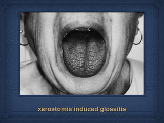 xerostomia induced glossitis
 