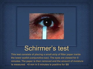 Schirmer’s test
This test consists of placing a small strip of filter paper inside
the lower eyelid (conjunctiva sac). The eyes are closed for 5
minutes. The paper is then removed and the amount of moisture
is measured. <5 mm in 5 minutes is positive for SS
 