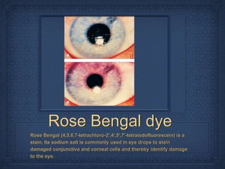 Rose Bengal dye
Rose Bengal (4,5,6,7-tetrachloro-2',4',5',7'-tetraiodofluorescein) is a
stain. Its sodium salt is commonly used in eye drops to stain
damaged conjunctiva and corneal cells and thereby identify damage
to the eye.
 