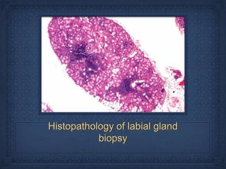 Histopathology of labial gland
           biopsy
 