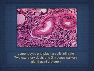 Lymphocytic and plasma cells infiltrate
Two excretory ducts and 3 mucous salivary
          gland acini are seen
 