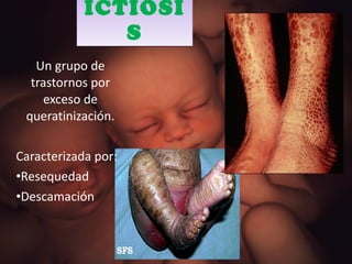 ICTIOSIS Un grupo de trastornos por exceso de queratinización. Caracterizada por: Resequedad Descamación 