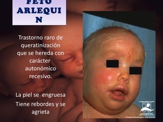 FETO ARLEQUIN Trastorno raro de queratinización que se hereda con carácter  autonómico recesivo. La piel se  engruesa  Tiene rebordes y se agrieta 