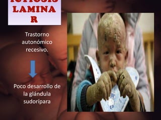 ICTIOSIS LAMINAR Trastorno autonómico recesivo. Poco desarrollo de la glándula sudorípara 