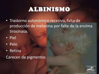 ALBINISMO Trastorno autonómico recesivo, falta de producción de melanina por falte de la enzima tirosinasa. Piel Pelo Retina Carecen de pigmentos 