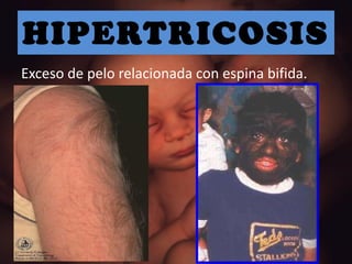 HIPERTRICOSIS Exceso de pelo relacionada con espina bifida. 
