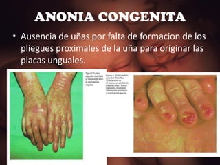 ANONIA CONGENITA Ausencia de uñas por falta de formacion de los pliegues proximales de la uña para originar las placas unguales. 