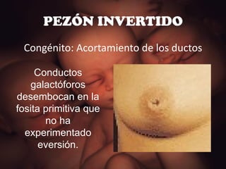 PEZÓN INVERTIDO Congénito: Acortamiento de los ductos Conductos galactóforos desembocan en la fosita primitiva que no ha experimentado eversión. 