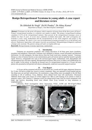 IOSR Journal of Dental and Medical Sciences (IOSR-JDMS)
e-ISSN: 2279-0853, p-ISSN: 2279-0861.Volume 14, Issue 11 Ver. IV (Nov. 2015), PP 74-76
www.iosrjournals.org
DOI: 10.9790/0853-141147476 www.iosrjournals.org 74 | Page
Benign Retroperitoneal Teratoma in young adult--A case report
and literature review
Dr.Abhishek Kr Singh1
,Dr.H.I Pandey2
, Dr.Abhay Kumar3
Department of Surgery, Tata Main Hospital, Jamshedpur
Abstract: Teratomas are the germ cell tumours which comprises of tissues from all the three germ cell layers.
Primary retroperitoneal teratoma is a relatively rare tumour in adults. The primary retroperitoneal teratoma
constitutes 6–11% of the retroperitoneal tumours. Sixty percent of the retroperitoneal teratomas occur in
children less than 15 years. It occurs more commonly in females than males. The order of frequency for
teratoma is ovary, testis, mediastinum and the retroperitoneum at last. Early diagnosis and surgery is the
mainstay of treatment. We report a rare case of retroperitoneal teratoma presented to us as left parietal wall
abscess. Exploratory laparotomy with tumour resection was performed. Histopathological diagnosis confirmed
a benign cystic teratoma. The patient is doing well and is on regular follow up.
Keywords: Retroperitoneum, teratoma, laparotomy, mediastinum
I. Introduction
Teratomas are uncommon neoplasm‟s that contain derivatives of all three germ layers (ectoderm,
mesoderm and endoderm). Historically, teratomas were attributed to demons, sexual misconduct and abnormal
fertilization. As with teratogenic, the name derives from the Greek word teras, meaning „monster‟. Teratomas
belong to a class of tumours known as non-seminomatous germ cell tumour and are typically located in gonadal
region. However, extragonadal sites such as the sacrococcygeal region, mediastinum, neck, diancephalon and
retroperitoneum have also been reported. Retroperitoneal teratomas often occur in infancy and childhood but are
rare in adults. In this article, we describe an unusual case of a retroperitoneal teratoma in a 18-year old male
patient who presented as left parietal wall abscess subsequently, underwent successful surgical resection.
II. Case Report
A 18-year old boy presented with fever on and off for last 1 month and left upper abdominal distension
for 15 days. He had no weight loss, bowel or urinary complaints. Mass was aspirated at local hospital and pus
like thing came out and later referred here. On examination, a large diffuse mass was palpable in the left flank
extending to left of umbilicus. X-ray Abdomen shows dilated bowel loop with calcification. Ultrasound
Abdomen shows large cystic lesion of 7x10cm (approx.Vol. 400 cc) with layering of its content is noted in
epigastric region. Non Contrast CT abdomen reveal few dilated bowel loops with few bowel entrapment with
target sign positive, descending bowel more dilated. Chest X-ray revealed no lung metastases or
lymphadenopathy.
Laboratory blood investigations shows leucocytosis W.B.C 14,500 and Hb-10.5gm%.Others
parameters were within normal limit. Tumour marker AFP, B-HCG and LDH were within normal values.
Fig.1 X-ray Abdomen shows calcification with dilated bowel Fig 2.NCCT scan showing mass with
the presence of calciﬁcation.
 