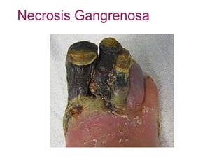 Necrosis Gangrenosa
 