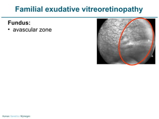 Familial exudative vitreoretinopathy Fundus: avascular zone 
