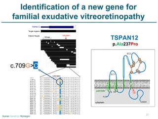 Identification of a new gene for familial exudative vitreoretinopathy TSPAN12  p. Ala 237 Pro c.709 G > C 