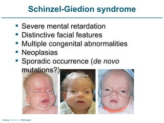 Schinzel-Giedion syndrome Severe mental retardation Distinctive facial features Multiple congenital abnormalities Neoplasias Sporadic occurrence ( de novo  mutations?) 
