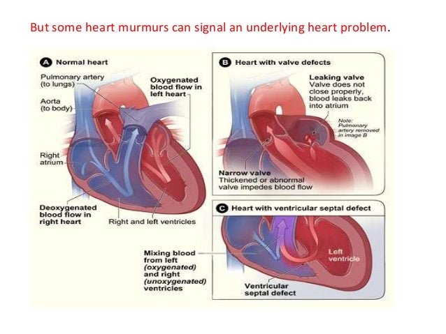 Heart Murmur heart-murmur