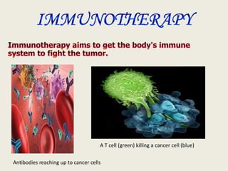 A T cell (green) killing a cancer cell (blue)
Antibodies reaching up to cancer cells
 