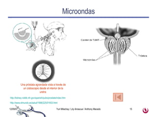 Microondas http://www.elmundo.es/salud/1996/225/01653.html   http://kidney.niddk.nih.gov/spanish/pubs/prostate/index.htm   Una próstata agrandada vista a través de un cistoscopio desde el interior de la uretra  