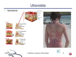 Ultravioleta Quemaduras 