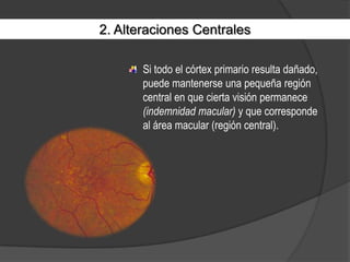 2. Alteraciones CentralesSi todo el córtex primario resulta dañado, puede mantenerse una pequeña región central en que cierta visión permanece (indemnidad macular) y que corresponde al área macular (región central).