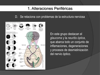 1. Alteraciones PeriféricasSe relaciona con problemas de la estructura nerviosaEn este grupo destacan el glaucoma y la neuritis óptica, que abarca todo un conjunto de inflamaciones, degeneraciones y procesos de desmielinización del nervio óptico.