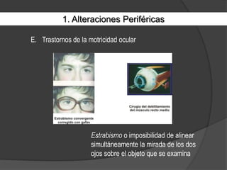 1. Alteraciones PeriféricasTrastornos de la motricidad ocularEstrabismo o imposibilidad de alinear simultáneamente la mirada de los dos ojos sobre el objeto que se examina
