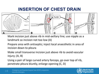 Emergency and Essential Surgical Care (EESC) programme
www.who.int/surgery
25 |
INSERTION OF CHEST DRAIN
Mark incision just above rib in mid-axillary line; use nipple as a
landmark so incision not too low (A)
Prepare area with antiseptic; inject local anaesthetic in area of
incision down to pleura
Make small transverse incision just above rib to avoid vascular
injury; (A, B)
Using a pair of large curved artery forceps, go over top of rib,
penetrate pleura bluntly, enlarge opening (C, D)
A B C D
NAV
 