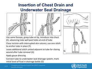 Emergency and Essential Surgical Care (EESC) programme
www.who.int/surgery
26 |
Insertion of Chest Drain and
Underwater Seal Drainage
Use same forceps, grasp tube at tip, introduce into chest
(E), advancing tube well past holes at end of tube
Close incision with interrupted skin sutures; use one stitch
to anchor tube in place (F)
Leave additional stitch untied adjacent to tube for closing
wound after tube removal (G)
Apply gauze dressing
Connect tube to underwater-seal drainage system, mark
initial level of fluid in drainage bottle (G)
E F
G
 