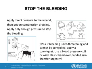 Emergency and Essential Surgical Care (EESC) programme
www.who.int/surgery
30 |
STOP THE BLEEDING
Apply direct pressure to the wound,
then put on compression dressing.
Apply only enough pressure to stop
the bleeding.
ONLY if bleeding is life-threatening and
cannot be controlled, apply a
tourniquet. Use a blood pressure cuff
or wide elastic band over padded skin.
Transfer urgently!
Direct pressure
 