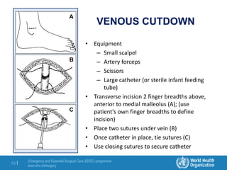 Emergency and Essential Surgical Care (EESC) programme
www.who.int/surgery
58 |
VENOUS CUTDOWN
• Equipment
– Small scalpel
– Artery forceps
– Scissors
– Large catheter (or sterile infant feeding
tube)
• Transverse incision 2 finger breadths above,
anterior to medial malleolus (A); (use
patient's own finger breadths to define
incision)
• Place two sutures under vein (B)
• Once catheter in place, tie sutures (C)
• Use closing sutures to secure catheter
A
B
C
 