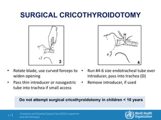 Emergency and Essential Surgical Care (EESC) programme
www.who.int/surgery
61 |
SURGICAL CRICOTHYROIDOTOMY
• Rotate blade, use curved forceps to
widen opening
• Pass thin introducer or nasogastric
tube into trachea if small access
• Run #4-6 size endotracheal tube over
introducer, pass into trachea (D)
• Remove introducer, if used
4
Do not attempt surgical cricothyroidotomy in children < 10 years
 
