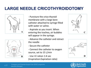 Emergency and Essential Surgical Care (EESC) programme
www.who.int/surgery
62 |
LARGE NEEDLE CRICOTHYROIDOTOMY
- Puncture the crico-thyroid
membrane with a large bore
catheter attached to syringe filled
with water or saline.
- Aspirate as you insert. When
entering the trachea, air bubbles
will appear in the syringe.
- Advance the catheter and retract
the needle
- Secure the catheter
- Connect the catheter to oxygen
source, set to 15 L/min
- Use I:E ration 1:4 sec
(Inspiration:Expiration ratio)
A
B
C
D
 