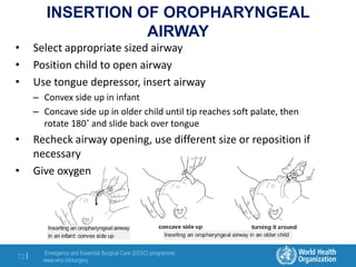 Emergency and Essential Surgical Care (EESC) programme
www.who.int/surgery
72 |
INSERTION OF OROPHARYNGEAL
AIRWAY
• Select appropriate sized airway
• Position child to open airway
• Use tongue depressor, insert airway
– Convex side up in infant
– Concave side up in older child until tip reaches soft palate, then
rotate 180˚ and slide back over tongue
• Recheck airway opening, use different size or reposition if
necessary
• Give oxygen
 
