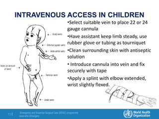 Emergency and Essential Surgical Care (EESC) programme
www.who.int/surgery
75 |
INTRAVENOUS ACCESS IN CHILDREN
•Select suitable vein to place 22 or 24
gauge cannula
•Have assistant keep limb steady, use
rubber glove or tubing as tourniquet
•Clean surrounding skin with antiseptic
solution
• Introduce cannula into vein and fix
securely with tape
•Apply a splint with elbow extended,
wrist slightly flexed.
 