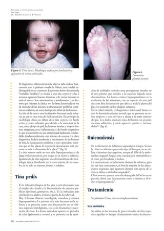 VENTANA A OTRAS ESPECIALIDADES
Las tiñas
J.L. Sánchez-Carazo y B. Martín
El diagnóstico diferencial en esta edad se debe realizar bási-
camente con la pitiriasis rosada de Gibert, una entidad in-
distinguible en su comienzo. La primera lesión denominada
“medallón heráldico” es similar a una tiña corporis y a las 2
semanas aparecen lesiones idénticas y de menor tamaño en
todo el tronco. Son asintomáticas y autolimitadas. Los fac-
tores que orientan la clínica son la forma lanceolada en vez
de numular de las lesiones, la descamación periférica conti-
nua en collarete,así como la erupción súbita de las lesiones.
La tiña de la cara es una localización frecuente en la infan-
cia, ya que es una zona de fácil exposición. En principio la
morfología clínica no difiere de la tiña corporis, con borde
activo y centro aclarado, pero debido a la estructura de la
cara, con y al tipo de piel, las lesiones tienden a adoptar for-
mas irregulares, poco inflamatorias y de bordes imprecisos
lo que la convierten en una enfermedad fácilmente confun-
dible, fundamentalmente con lesiones de eccema. La clave
diagnóstica la da la tendencia al crecimiento de las lesiones
de tiña, la descamación periférica y poco apreciable, mien-
tras que en las placas de eccema la descamación está pre-
sente en toda la dimensión de la placa2,3 (fig. 5).
La tiña manum suele ser una tiña hiperqueratósica y de
larga evolución (años), por lo que no se da en la infancia.
Igualmente, la tiña inguinal, una dermatofitosis de mor-
fología típica distribuida en la cara interna de los mus-
los, se da sólo en varones jóvenes o adultos.
Tiña pedis
Es la infección fúngica de los pies y está relacionada con
el empleo de calzado y la frecuentación de espacios pú-
blicos (piscinas, gimnasios, etc.). Es la infección más
prevalente en adultos jóvenes a partir de la pubertad.
Hay 3 formas clínicas: interdigital, vesiculosa y crónica
hiperqueratósica. La primera es la más frecuente en la in-
fancia y se presenta como una descamación en los últi-
mos espacios interdigitales, con o sin fisuración y mace-
ración de éstos. La forma vesiculosa aparece en períodos
de calor (primavera y verano) y se presenta con la apari-
116 An Pediatr Contin. 2007;5(2):114-7
Figura 5. Tiña faciei. Morfología atípica por localización y
aplicación de cremas corticoides.
Figura 6.
Dermatitis
plantar juvenil.
ción de múltiples vesículas muy pruriginosas situadas en
el arco plantar que tienden a la curación dejando áreas
descamativas. La forma crónica hiperqueratósica es la
evolución de las anteriores, con un aspecto de una piel
seca con fina descamación que afecta a toda la planta del
pie, con aumento de los pliegues cutáneos.
En la edad infantil, el diagnóstico diferencial básico es
con la dermatitis plantar juvenil, que se presenta en ni-
ños atópicos o con piel seca y afecta a la parte anterior
del pie. Los dedos aparecen rojos, brillantes con grandes
escamas adheridas, y suele aparecer prurito e, incluso,
dolor2,3 (fig. 6).
Onicomicosis
Es la afectación de la lámina ungueal por hongos. Como
la clínica es idéntica para todo tipo de hongos, no se uti-
liza el término tiña unguium, aunque el 90% de la enfer-
medad ungueal fúngica está causada por dermatofitos y
el resto, por levaduras y mohos.
La onicomicosis es infrecuente durante la infancia, pero
no tan rara como parece, si bien la mayoría de las altera-
ciones ungueales que aparecen durante esta época de la
vida se deben a distrofias ungueales6.
Clínicamente aparece una uña despegada del lecho en su
porción distal con descamación entre la lámina y el le-
cho e hiperqueratosis7.
Tratamiento
Se plantean 2 vías, a veces complementarias.
Vía sistémica
Se utiliza en las lesiones de gran extensión de tiña corpo-
ris o aquellas en las que el tratamiento tópico ha fracasa-
 