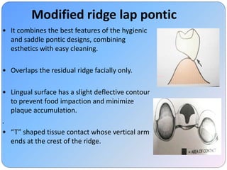Esthetics in FPD | PPTX