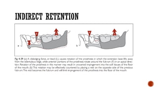 Indirect Retention In Rpd Biomechanical principles in removable partial dentures (rpd) | PPTX
