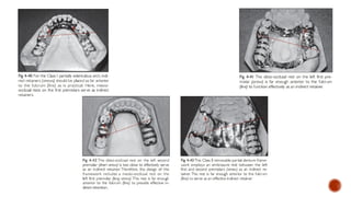 Biomechanical principles in removable partial dentures (rpd) | PPTX