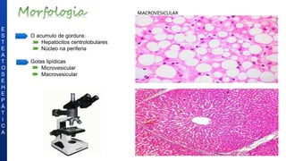 E
S
T
E
A
T
O
S
E
H
E
P
Á
T
I
C
A
MACROVESICULAR
• O acumulo de gordura:
• Hepatócitos centrolobulares
• Núcleo na periferia
• Gotas lipídicas
• Microvesicular
• Macrovesicular
 