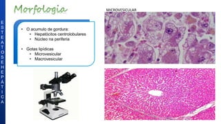 • O acumulo de gordura:
• Hepatócitos centrolobulares
• Núcleo na periferia
• Gotas lipídicas
• Microvesicular
• Macrovesicular
E
S
T
E
A
T
O
S
E
H
E
P
Á
T
I
C
A
MICROVESICULAR
 