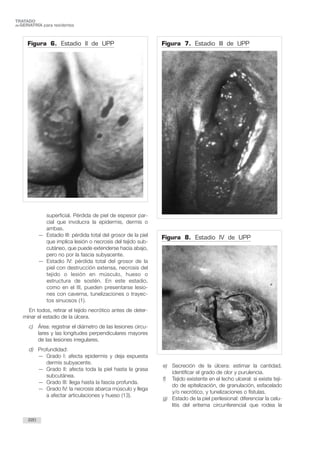 superficial. Pérdida de piel de espesor par-
cial que involucra la epidermis, dermis o
ambas.
— Estadio III: pérdida total del grosor de la piel
que implica lesión o necrosis del tejido sub-
cutáneo, que puede extenderse hacia abajo,
pero no por la fascia subyacente.
— Estadio IV: pérdida total del grosor de la
piel con destrucción extensa, necrosis del
tejido o lesión en músculo, hueso o
estructura de sostén. En este estadio,
como en el III, pueden presentarse lesio-
nes con caverna, tunelizaciones o trayec-
tos sinuosos (1).
En todos, retirar el tejido necrótico antes de deter-
minar el estadio de la úlcera.
c) Área: registrar el diámetro de las lesiones circu-
lares y las longitudes perpendiculares mayores
de las lesiones irregulares.
d) Profundidad:
— Grado I: afecta epidermis y deja expuesta
dermis subyacente.
— Grado II: afecta toda la piel hasta la grasa
subcutánea.
— Grado III: llega hasta la fascia profunda.
— Grado IV: la necrosis abarca músculo y llega
a afectar articulaciones y hueso (13).
e) Secreción de la úlcera: estimar la cantidad,
identificar el grado de olor y purulencia.
f) Tejido existente en el lecho ulceral: si existe teji-
do de epitelización, de granulación, esfacelado
y/o necrótico, y tunelizaciones o fístulas.
g) Estado de la piel perilesional: diferenciar la celu-
litis del eritema circunferencial que rodea la
220
TRATADO
deGERIATRÍA para residentes
Figura 6. Estadio II de UPP Figura 7. Estadio III de UPP
Figura 8. Estadio IV de UPP
 