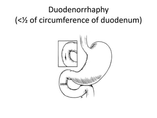 Duodenorrhaphy
(<½ of circumference of duodenum)
 