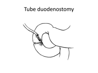 Tube duodenostomy
 