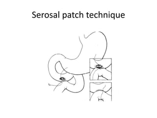 Serosal patch technique
 
