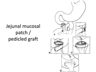 Jejunal mucosal
patch /
pedicled graft
 