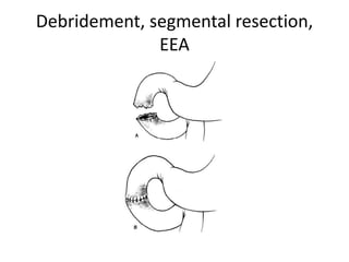 Debridement, segmental resection,
EEA
 