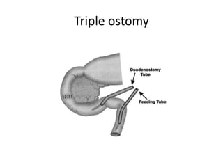 Triple ostomy
 